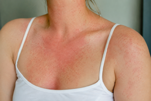 sonnenallergie